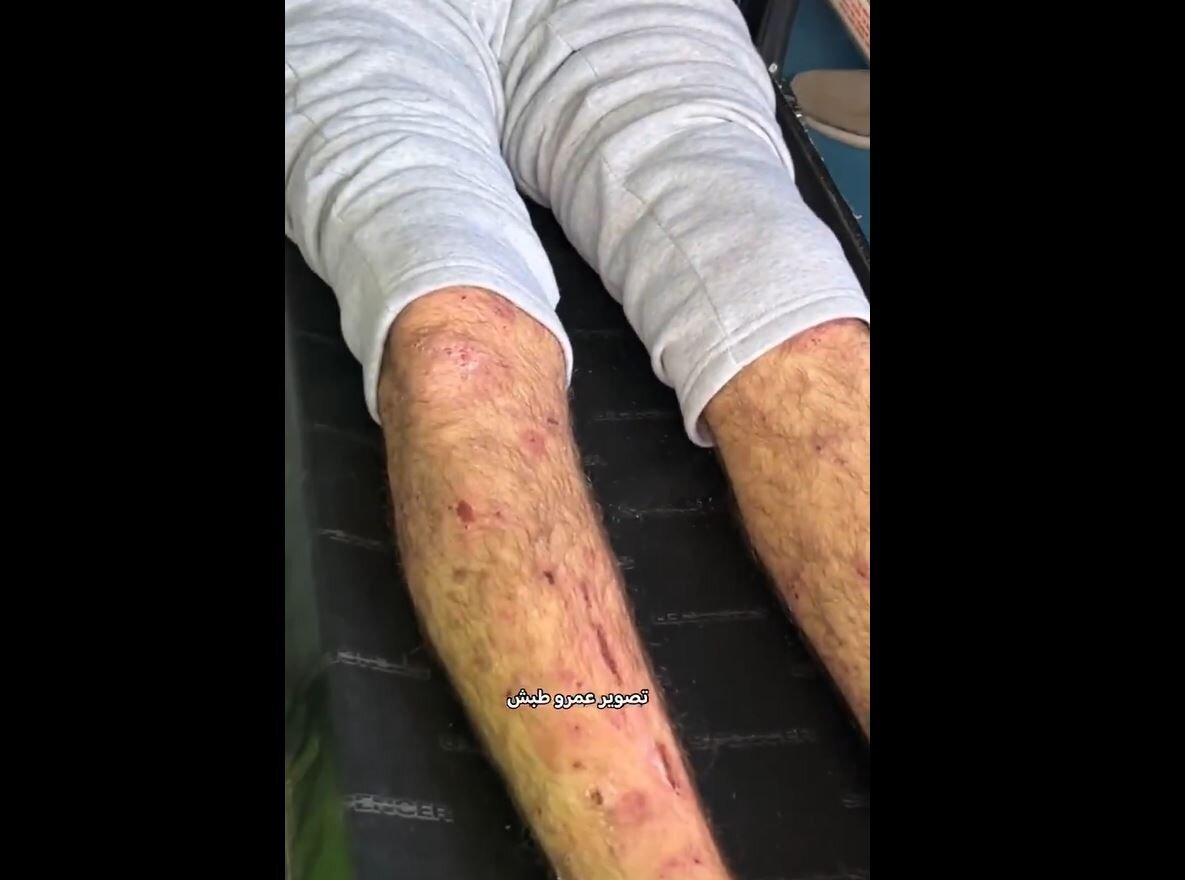 Video: Signs of torture on freed prisoners upon arrival at European Hospital in Southern Gaza