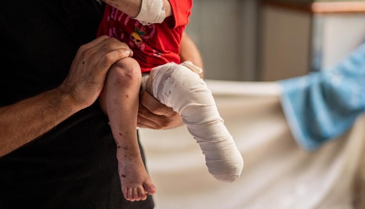 4,500 amputations reported in Gaza