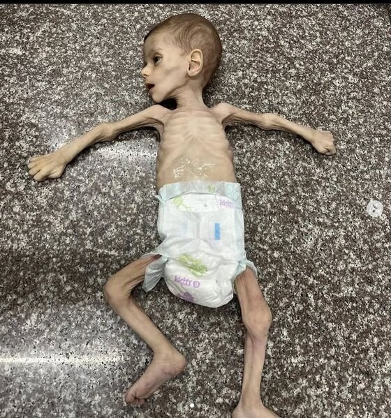 WHO warns of extreme famine levels in Gaza