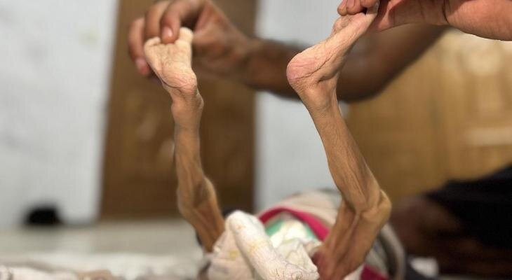 Three Palestinians die due to starvation in Gaza Strip in past 24 hours