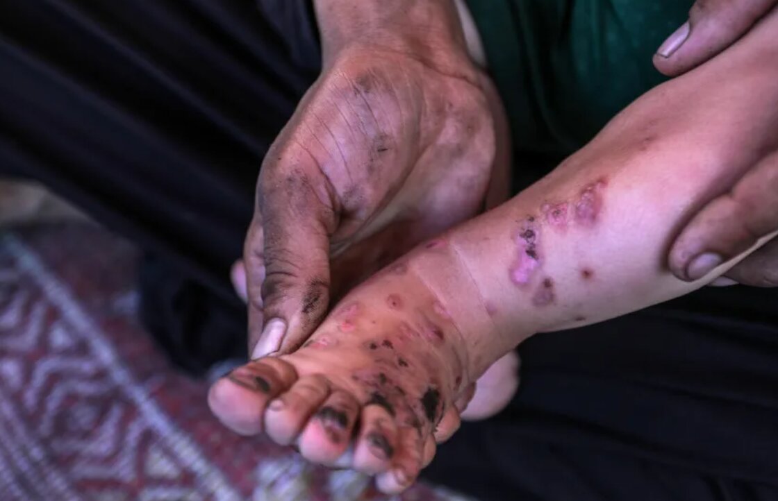 Skin infections surge in Gaza due to medicine shortages amid Israeli blockade: UNRWA